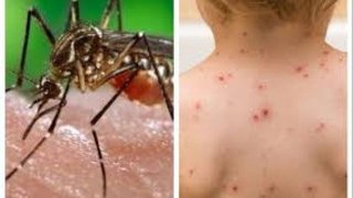 Confirman la muerte de un hombre por dengue y la de una mujer por sarampión