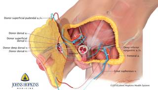 Se realizó el primer transplante completo de pene y escroto del mundo