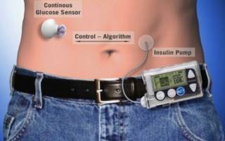 Un "páncreas artificial" para diabéticos asocia insulina y teléfonos móviles