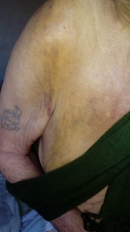 Tiene 77 años, se quebró la clavícula y no lo quieren operar: lo mandaron a la casa 