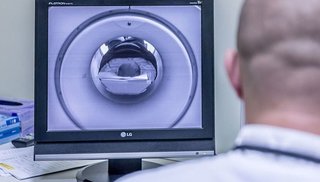 Hallan 100 huevos de tenia en el cerebro de una niña que padecía dolores de cabeza y convulsiones