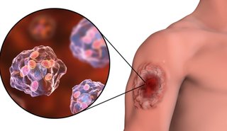 Brindan recomendaciones para prevenir la leishmaniasis