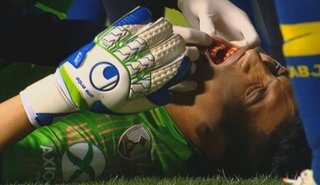 Video. Una mala para Boca: El arquero Esteban Andrada sufrió una fractura de mandíbula