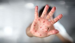 Brote de sarampión: una mujer antivacunas contagió a sus cinco hijos 