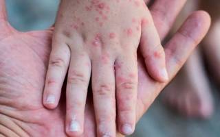 La OMS alerta ante un incremento en los brotes de sarampión en todo el mundo