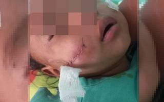  Tartagal: La beba mordida por un perro ya fue dada de alta