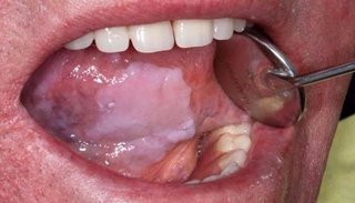 Concientizan sobre el cáncer bucal